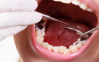 Reasons to Choose a Dental Prosthetist Clinic Southport QLD for Your Dental Care